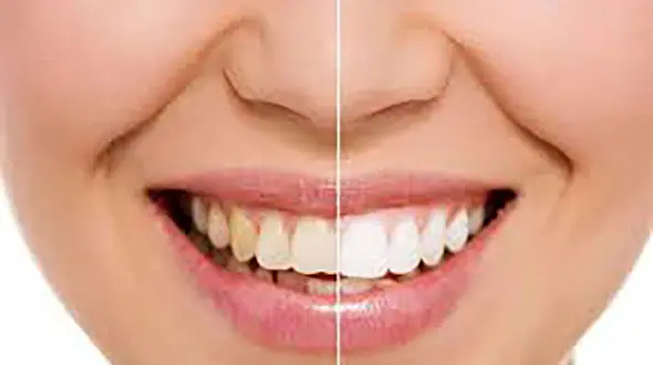 چطور می شود زردی دندان را از بین برد؟