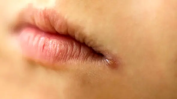 دلایل ترک خوردگی گوشه لب‌ها 