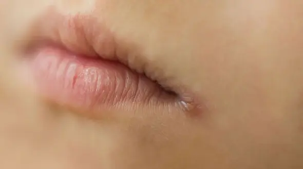 دلایل ترک خوردگی گوشه لب‌ها 