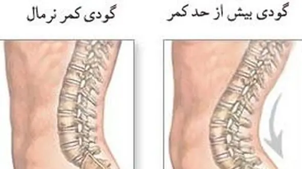 چرا به گودی کمر مبتلا می شویم؟