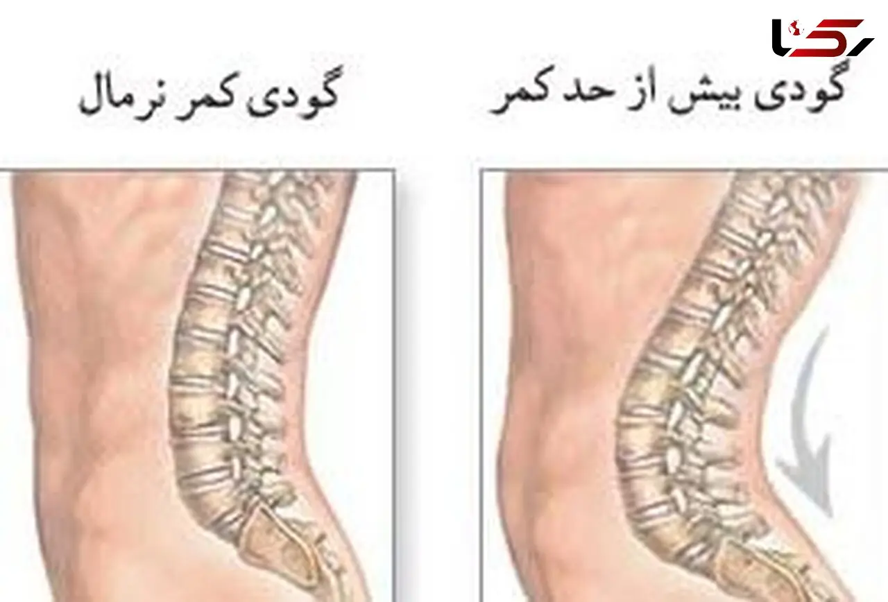 چرا به گودی کمر مبتلا می شویم؟