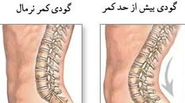 چرا به گودی کمر مبتلا می شویم؟