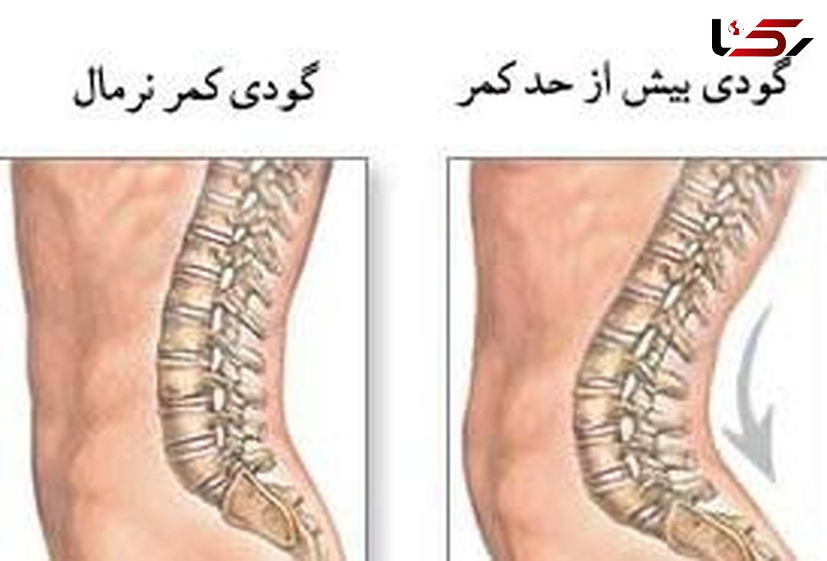 چرا به گودی کمر مبتلا می شویم؟