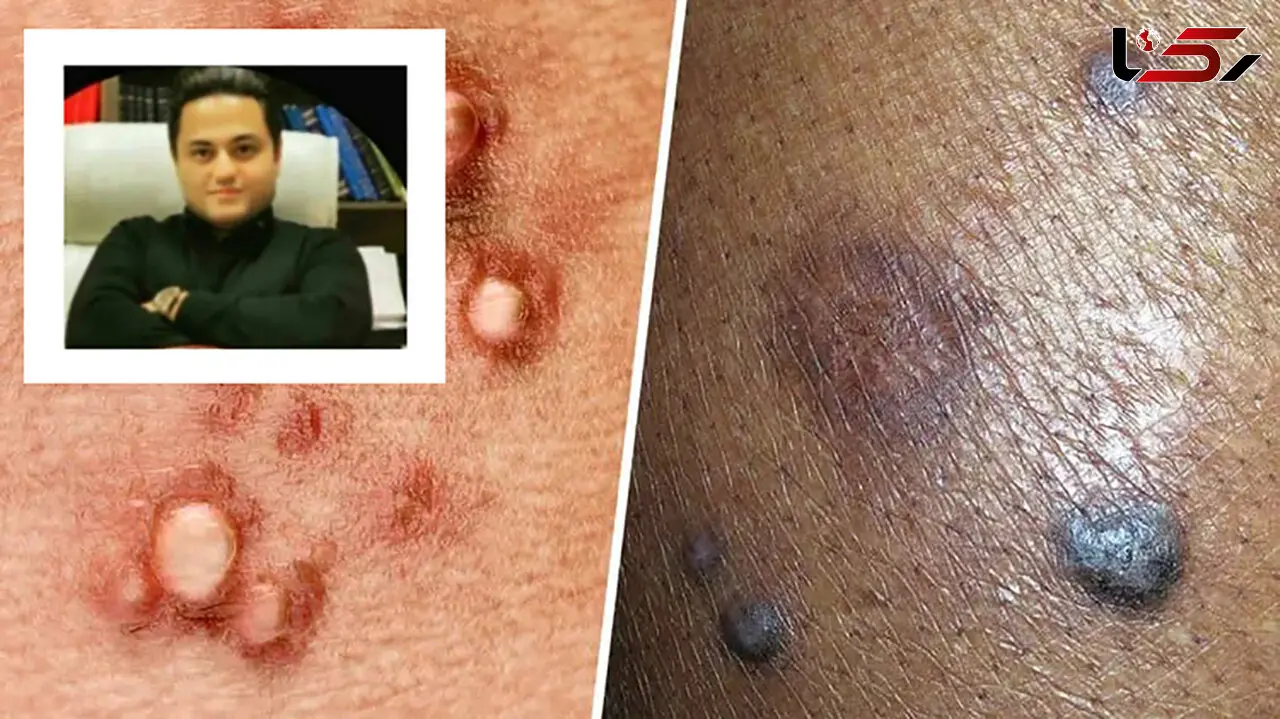 کشف داروی ریشه‌کنی کامل ویروس HPV توسط دانشمند ایرانی / دکتر مهدی والوزی : از مسئولان فقط انتظار حمایت داریم/ کشورهای عربی اعلام پشتیبانی کرده اند!  + فیلم