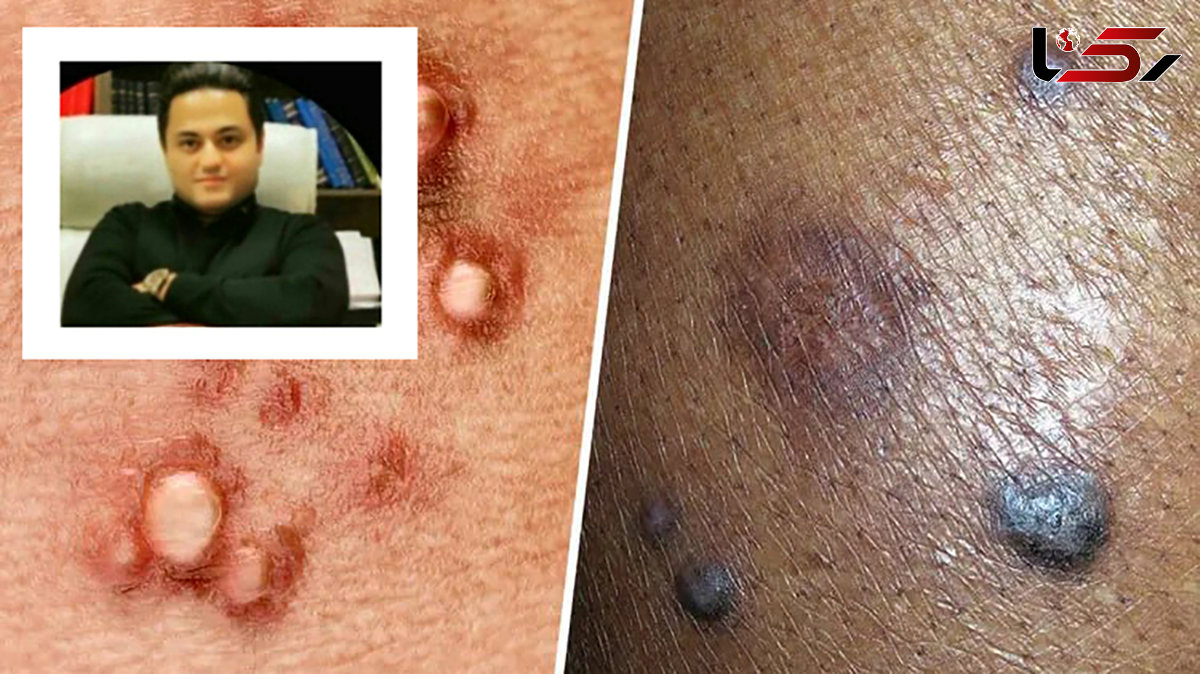 کشف داروی ریشه‌کنی کامل ویروس HPV توسط دانشمند ایرانی / دکتر مهدی والوزی : از مسئولان فقط انتظار حمایت داریم/ کشورهای عربی اعلام پشتیبانی کرده اند!  + فیلم