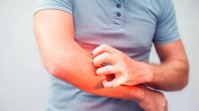 خارش آبله مرغان