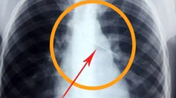 دختر اهوازی سر کلاس سوزن قورت داد /خانواده وی به مدرسه حمله کردند ! + عکس