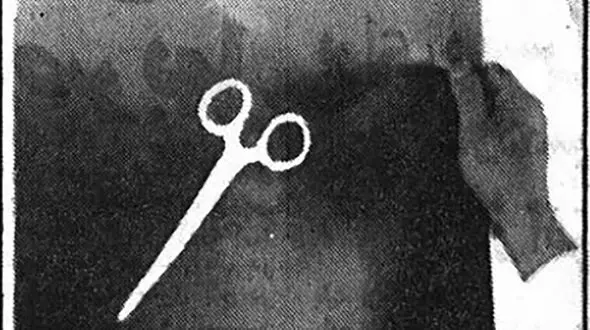  مرگ تلخ دختر 17 ساله بخاطر جا ماندن قیچی در شکمش  