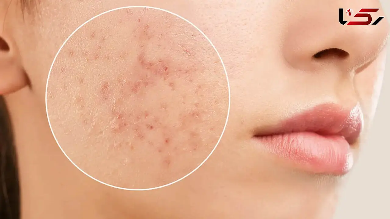 ایجاد آکنه با این اشتباهات روتین پوستی / اینفوگرافی