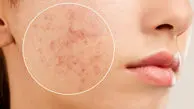 ایجاد آکنه با این اشتباهات روتین پوستی / اینفوگرافی