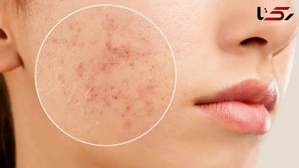 ایجاد آکنه با این اشتباهات روتین پوستی / اینفوگرافی