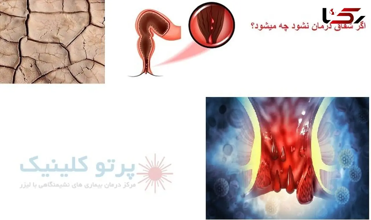 اگر شقاق درمان نشود چه میشود + عوارض عدم درمان