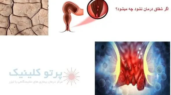 اگر شقاق درمان نشود چه میشود + عوارض عدم درمان