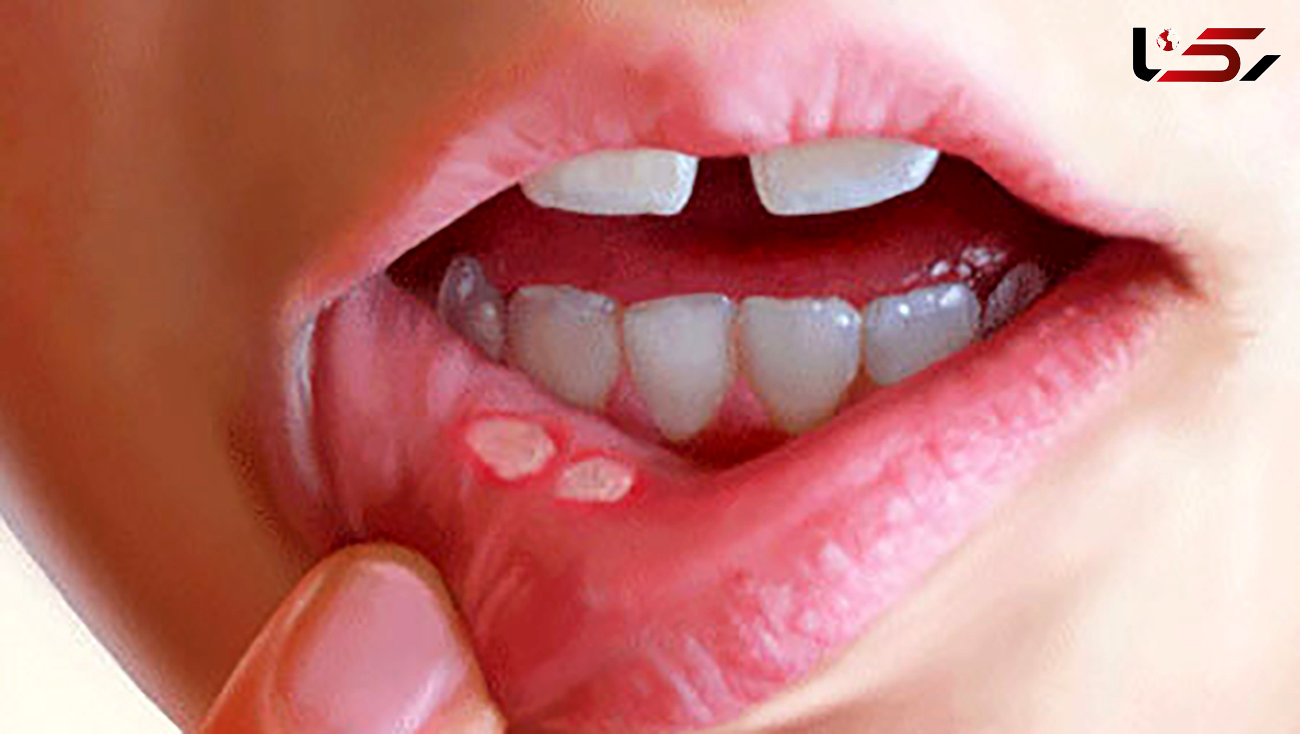 درمان آفت دهان با پروتئین 
