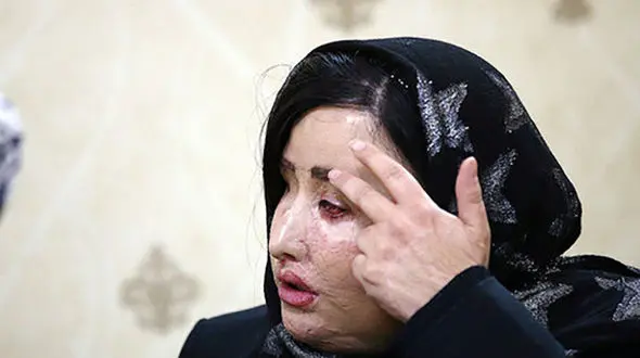 سهیلا جورکش قربانی اسیدپاشی های اصفهان چه روزگاری دارد؟!/مصاحبه خواندنی + عکس

