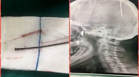 عکس عجیب از میخ فرو رفته در جمجمه مرد ایرانی + تصویر
