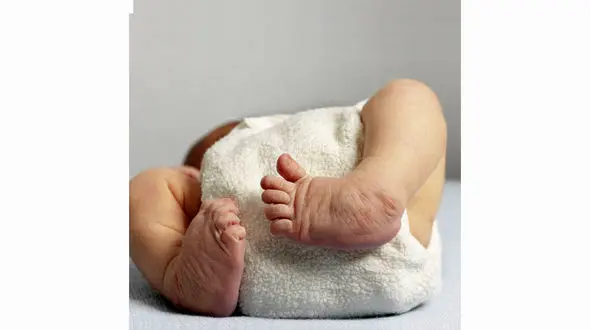 درمان میوتونی مادرزادی با دنیای شگفت انگیز طب سوزنی