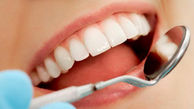 جرم گیری دندان چه فوایدی دارد؟
