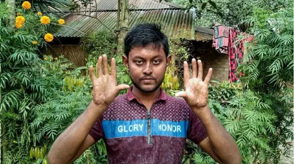 اعضای این خانواده اثر انگشت ندارند! +عکس
