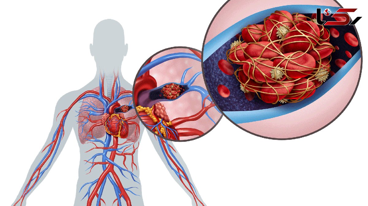  آمبولی چیست؟ / جدول انواع آمبولی، علل، علائم، تشخیص و درمان آمبولی 