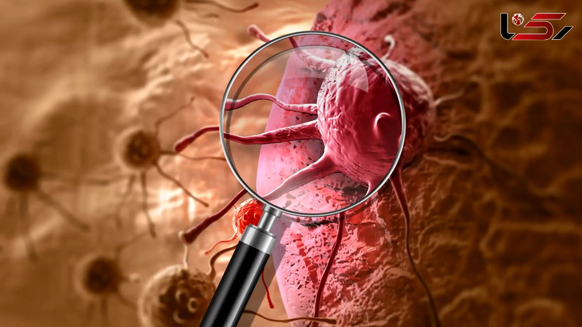 شیوع نگران‌ کننده سرطان در ایران: 131 هزار مورد جدید در سال