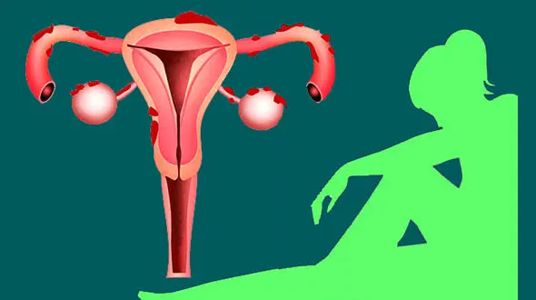 بهترین الگوی رژیم غذایی برای اندومتریوز / فیلم