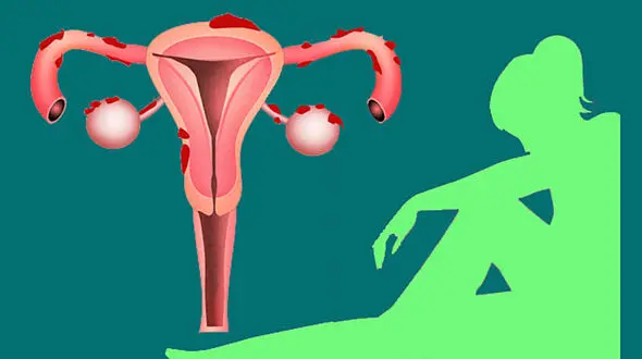 بهترین الگوی رژیم غذایی برای اندومتریوز / فیلم