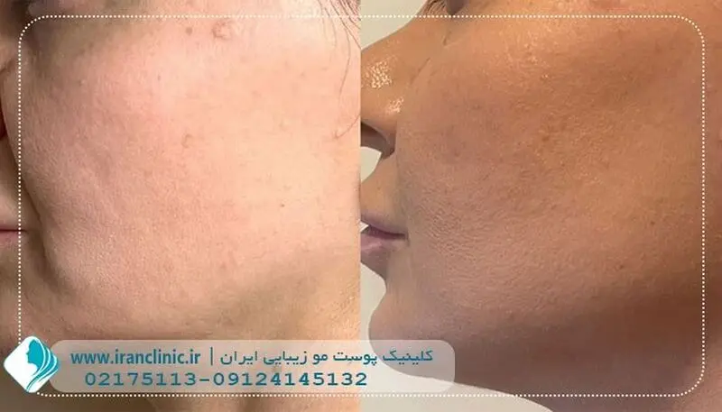 هایفو کلینیک ایران
