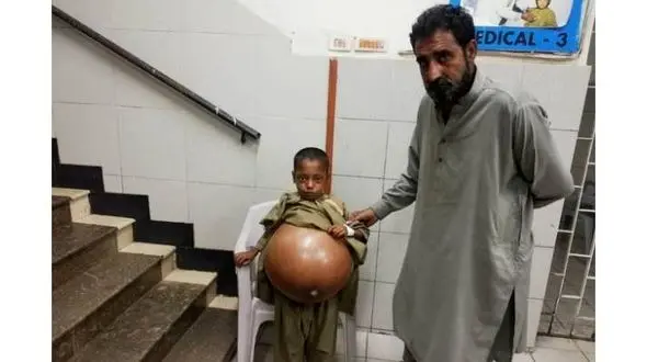 این پسر 9 ساله عجیب ترین درد را دارد! + عکس