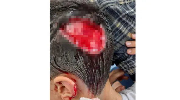 سگ های ولگرد پوست سر پسر 8 ساله را کندند / در شهر سهند رخ داد + عکس 