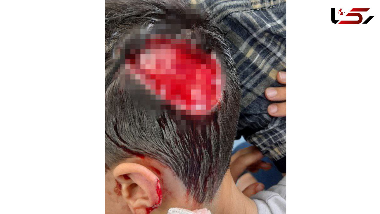 سگ های ولگرد پوست سر پسر 8 ساله را کندند / در شهر سهند رخ داد + عکس 