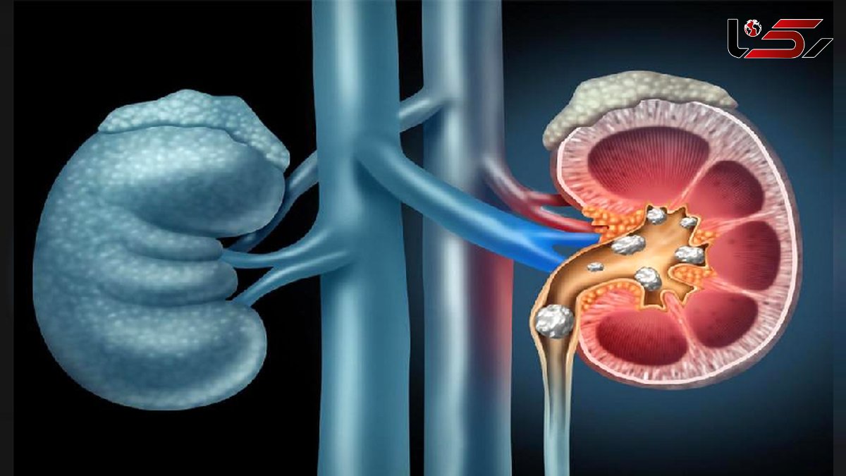 انواع سنگ های کلیه و روش دفع آن ها