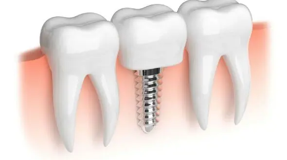 عوراض پنهان ایمپلنت دندان