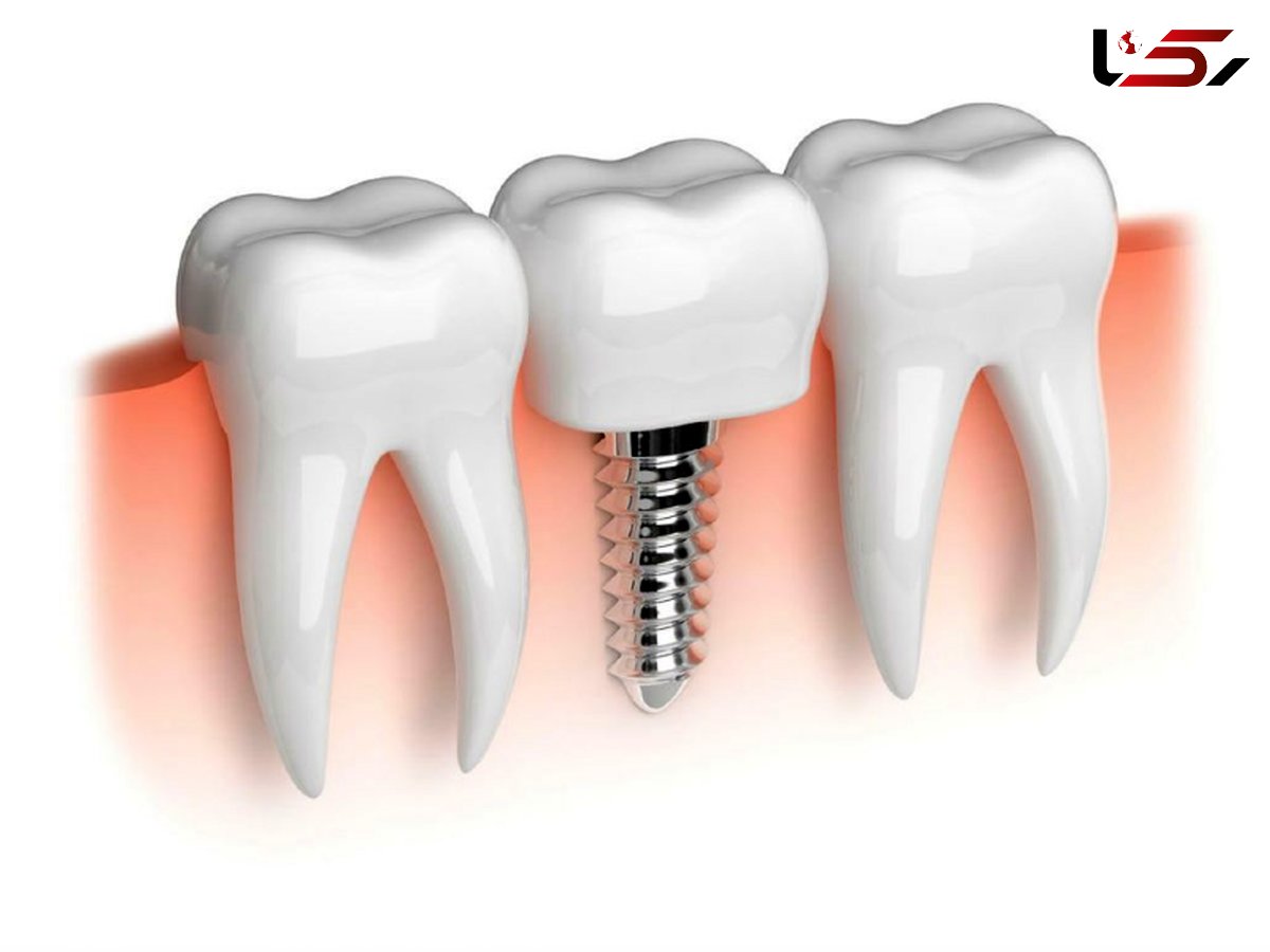 عوراض پنهان ایمپلنت دندان