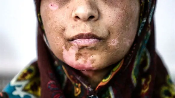 شوهر اعظم به ۳۰ سال حبس محکوم شد +عکس زن آسیب دیده مشهدی