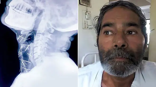چگونه 75 سوزن وارد بدن این مرد شد؟+ عکس