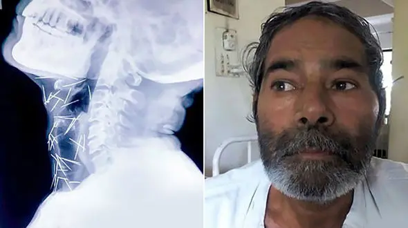 چگونه 75 سوزن وارد بدن این مرد شد؟+ عکس