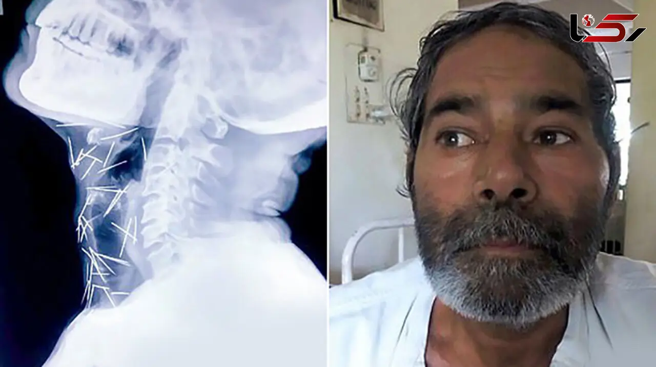 چگونه 75 سوزن وارد بدن این مرد شد؟+ عکس