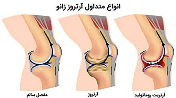 این باورها درباره آرتروز زانو اشتباه است