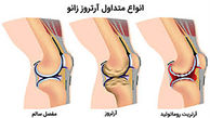این باورها درباره آرتروز زانو اشتباه است