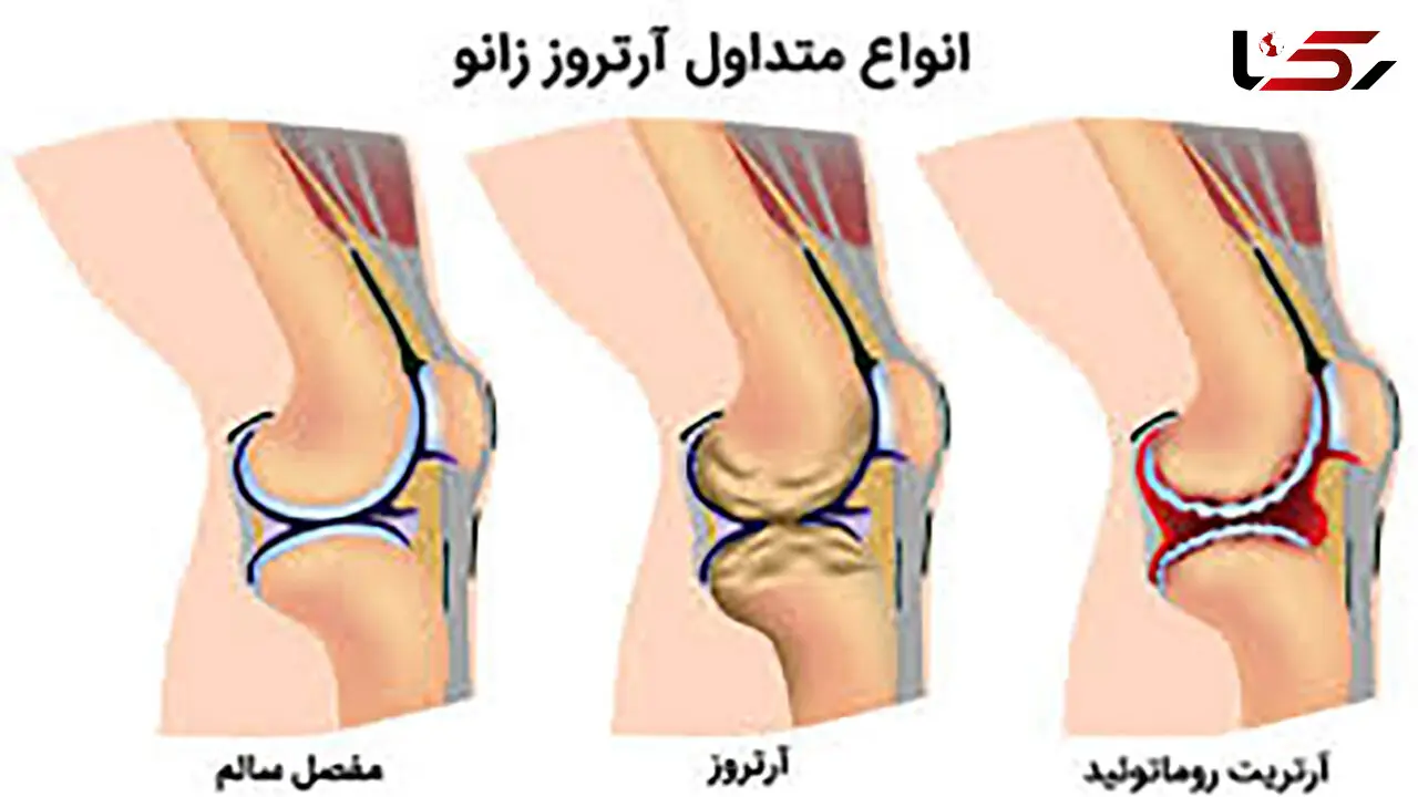 این باورها درباره آرتروز زانو اشتباه است