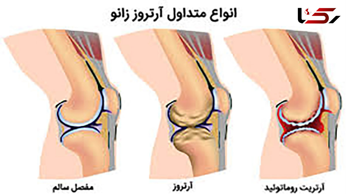 این باورها درباره آرتروز زانو اشتباه است