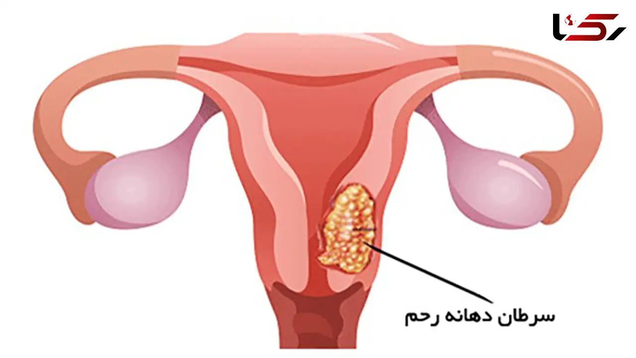 علل بروز سرطان دهانه رحم چیست؟