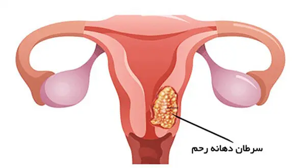 علل بروز سرطان دهانه رحم چیست؟