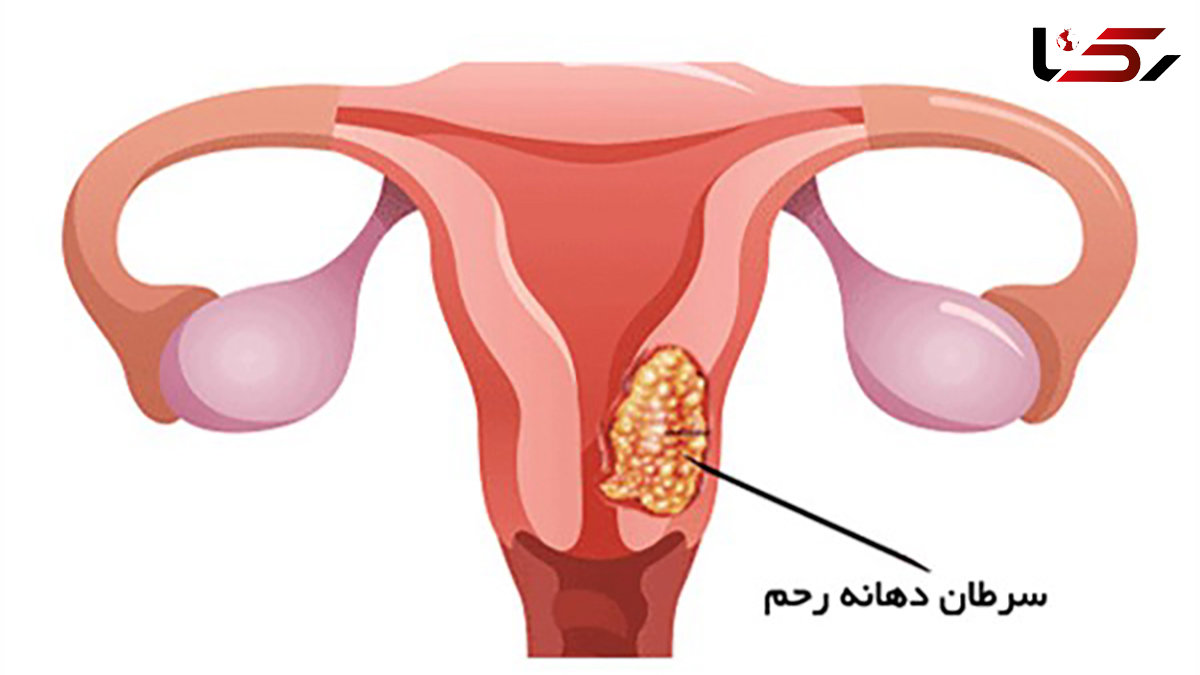 علل بروز سرطان دهانه رحم چیست؟