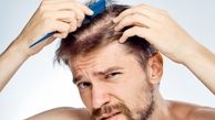 حدود 30 درصد مردان در 30 سالگی دچار ریزش مو می شوند/ برای کنترل، درمان باید به سرعت آغاز شود