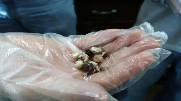 سنگ کیسه صفرا چه نشانه هایی دارد؟ + درمان سنتی