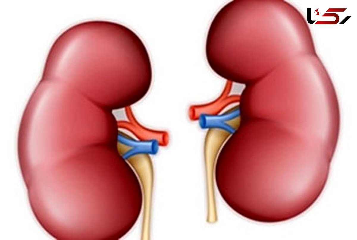 اگر این نشانه ها را دارید به سنگ کلیه مبتلا هستید