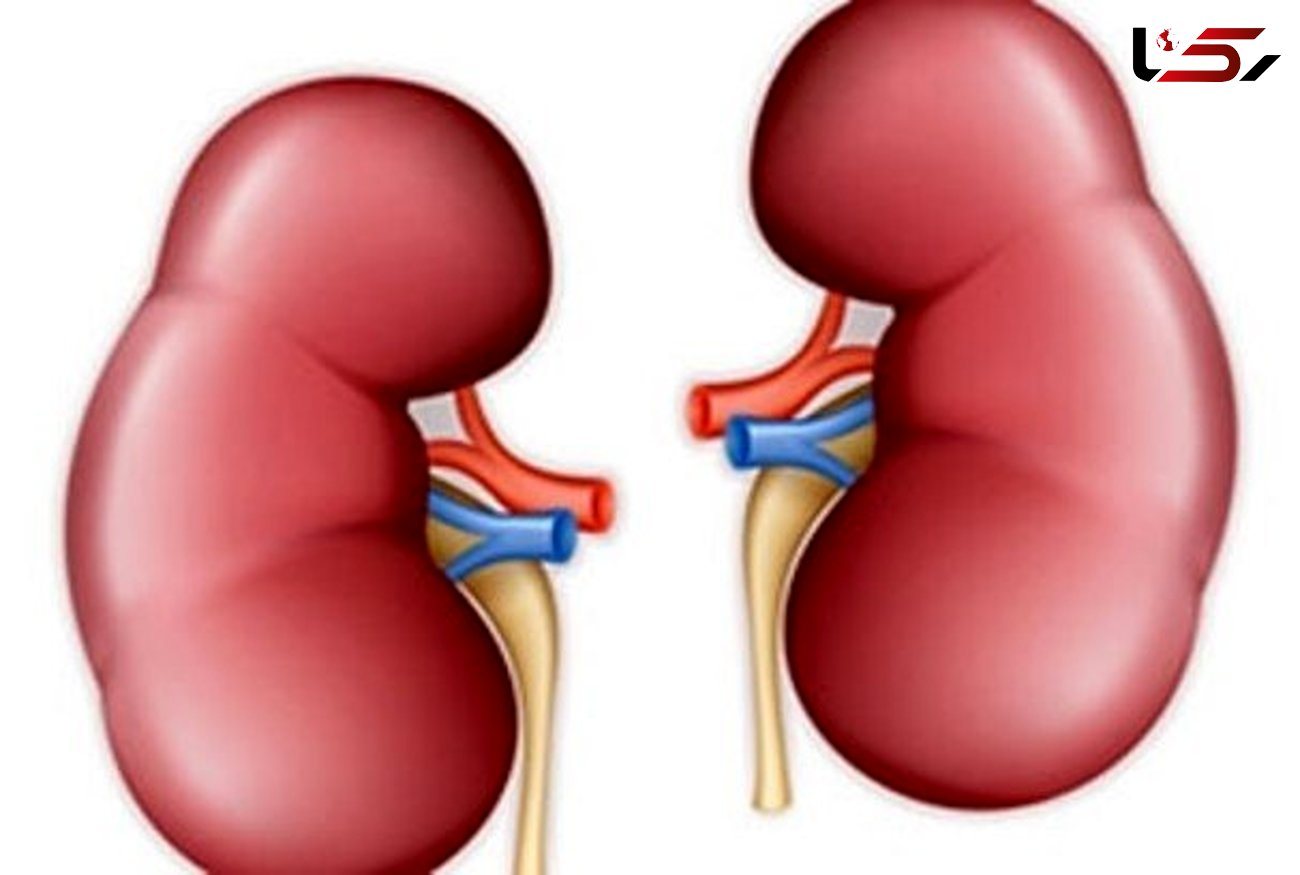 اگر این نشانه ها را دارید به سنگ کلیه مبتلا هستید