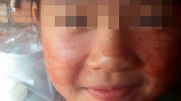 این دختر خون عرق می کند! + عکس 